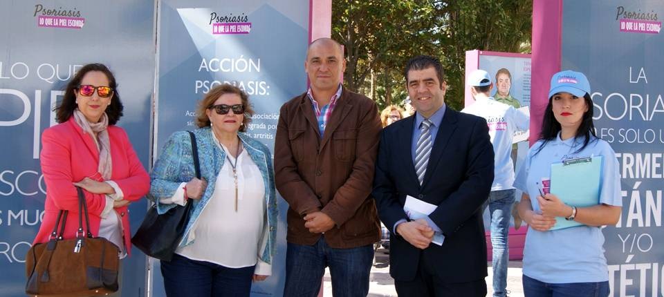 Más de 1.300 personas en Motril padecen psoriasis